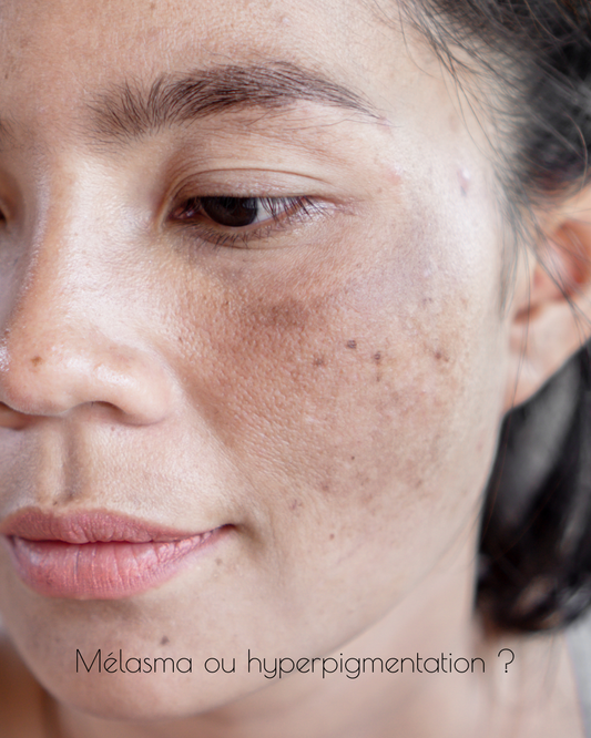 Hyperpigmentation ou mélasma : comment faire la différence?